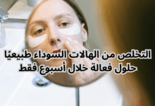 التخلص من الهالات السوداء